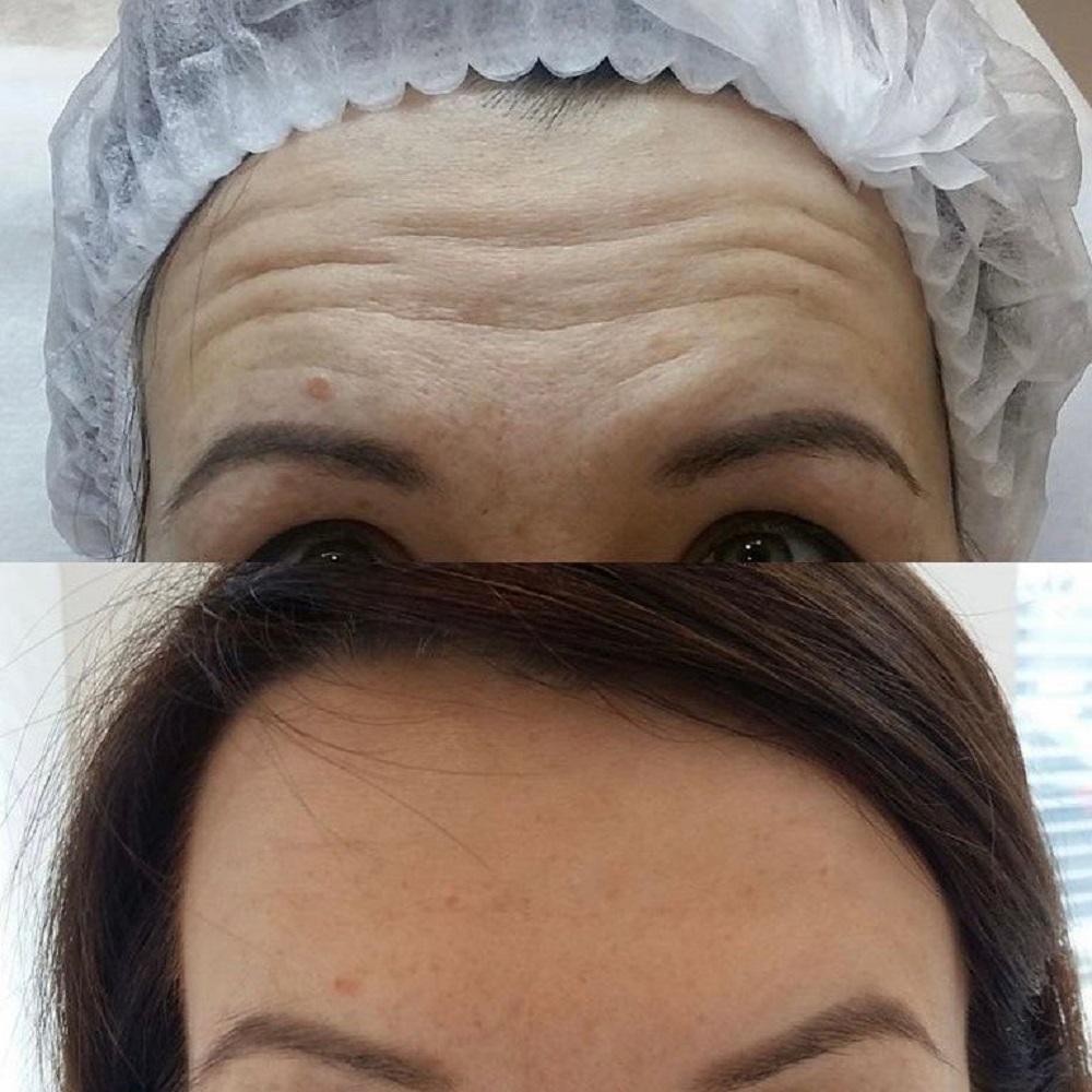 Филлеры для лица: фото до и после процедуры - визуальные трансформации