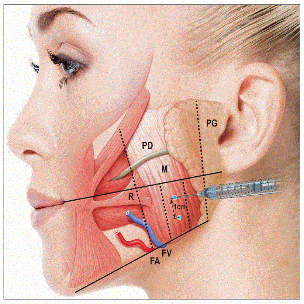 Углы челюсти филлером: определение контуров лица