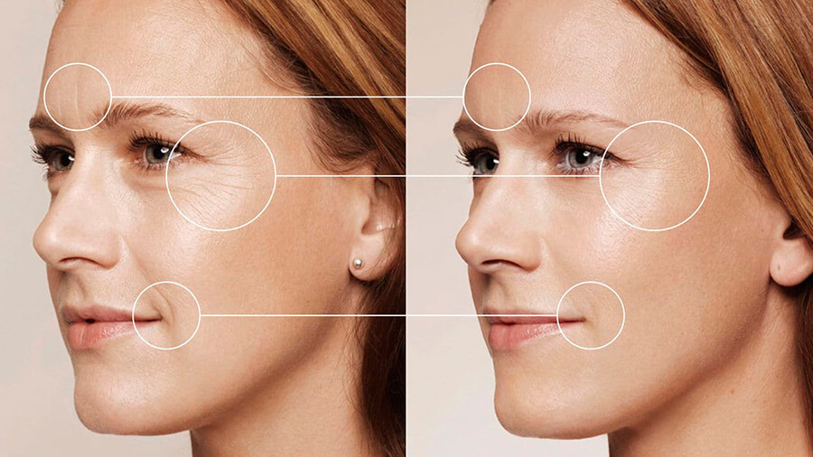 Процедура филлеры для лица: эффективные инъекции для укрепления, увлажнения и омоложения кожи
